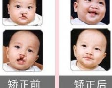吃兔肉真的會(huì)長兔唇？為什么會(huì)長兔唇？